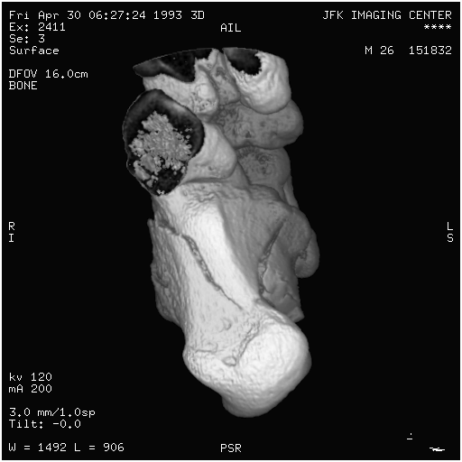 Baseline/CT-MONO2-16-ankle.png