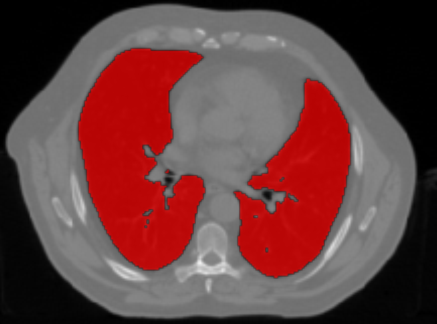 lung-overlay.png